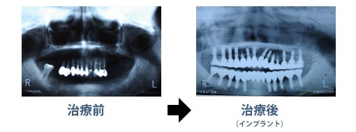 インプラント治療